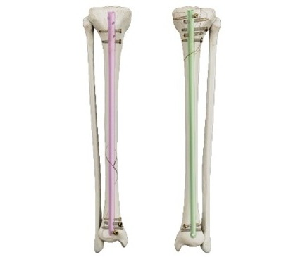 Image: The TRIGEN MAX tibia nailing system offers stability and reduces post-operative soft tissue irritation (Photo courtesy of Smith+Nephew)